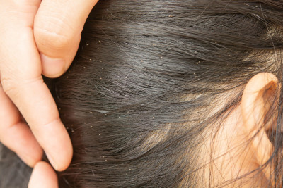 Coba Sendiri, Ini 3 Cara Menghilangkan Kutu Rambut!